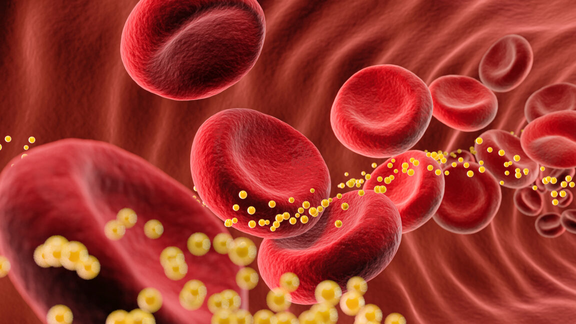 Bad cholesterol slashed 62% by single dose of gene-editing drug in small trial - Ars Technica