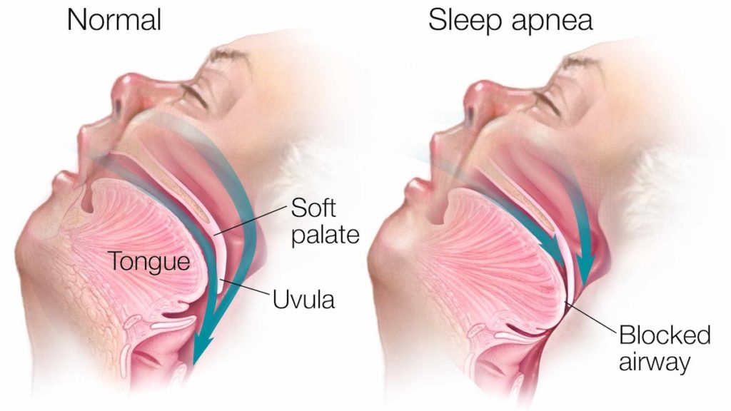 Understanding Sleep Apnea and Why Detection Matters - contextual illustration