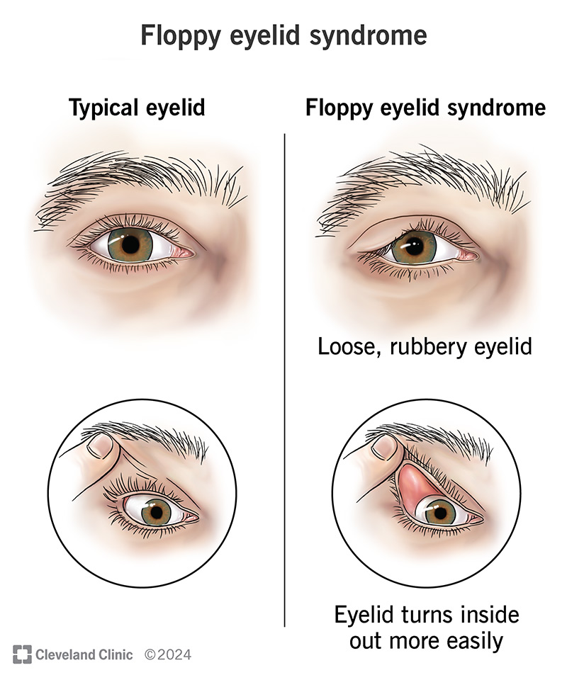 The Connection Between Sleep Apnea and Drooping Eyelids - visual representation
