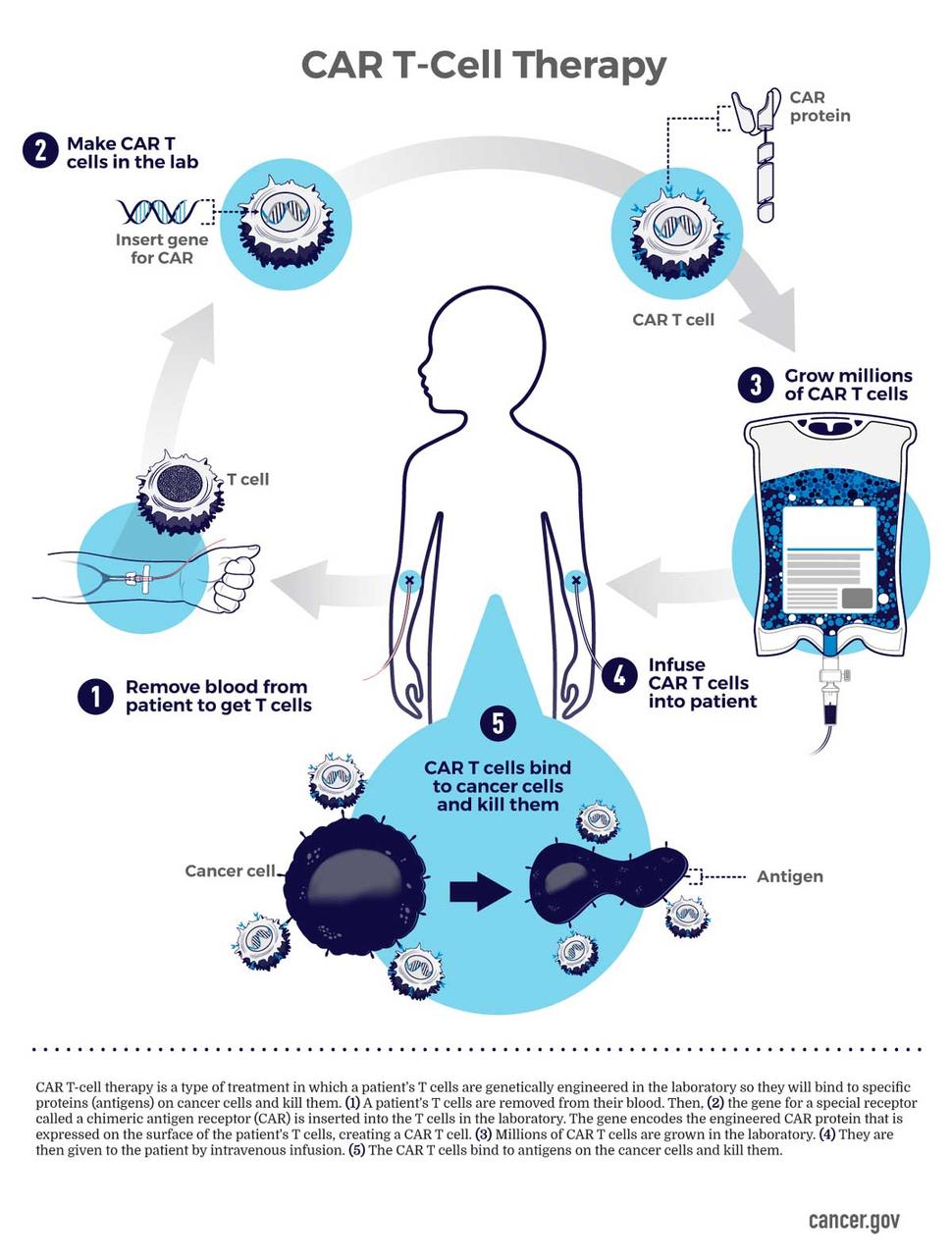 The Promise of CAR T Cell Therapy in Autoimmune Diseases - visual representation