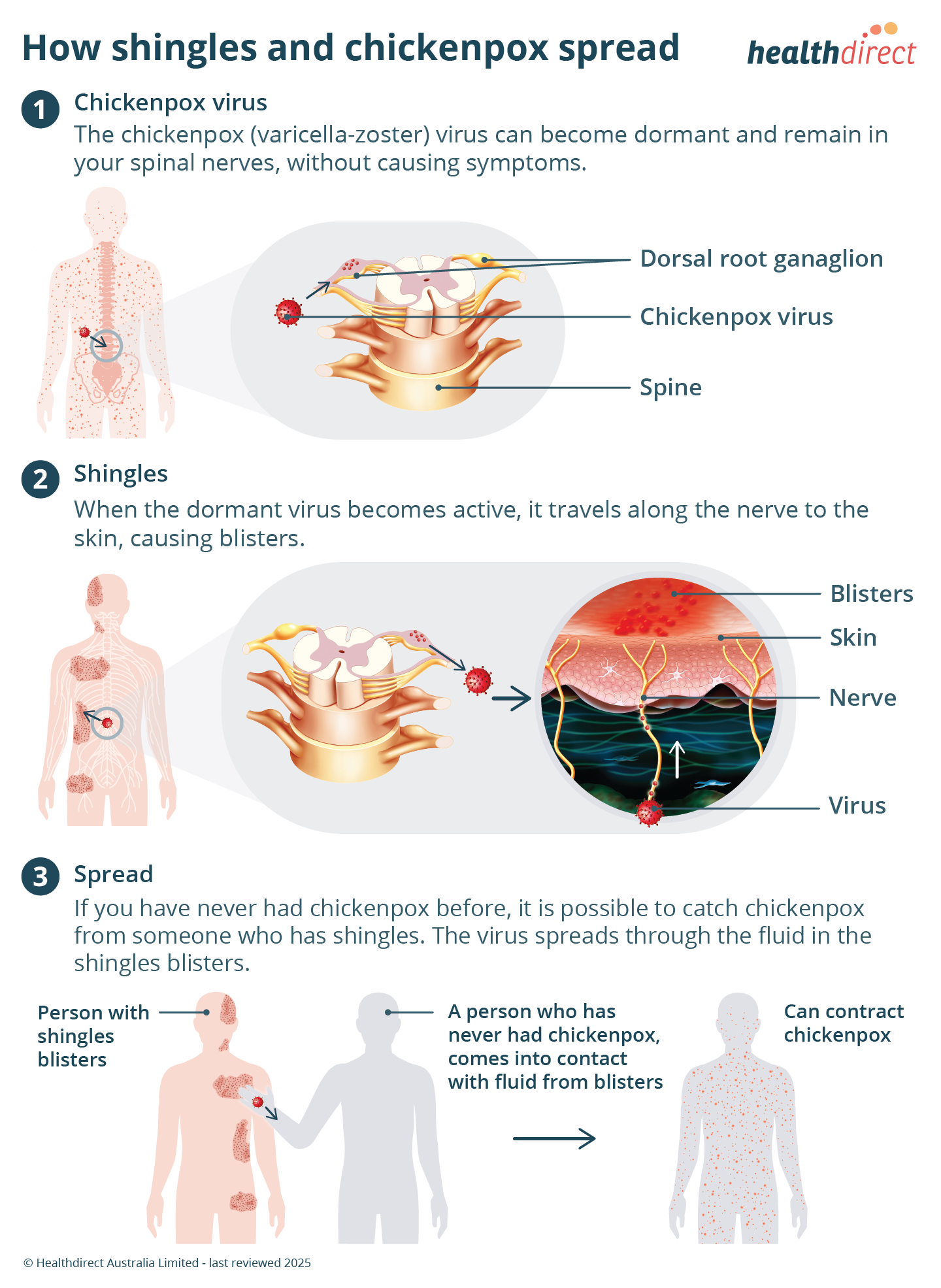 Understanding the Shingles Virus - visual representation