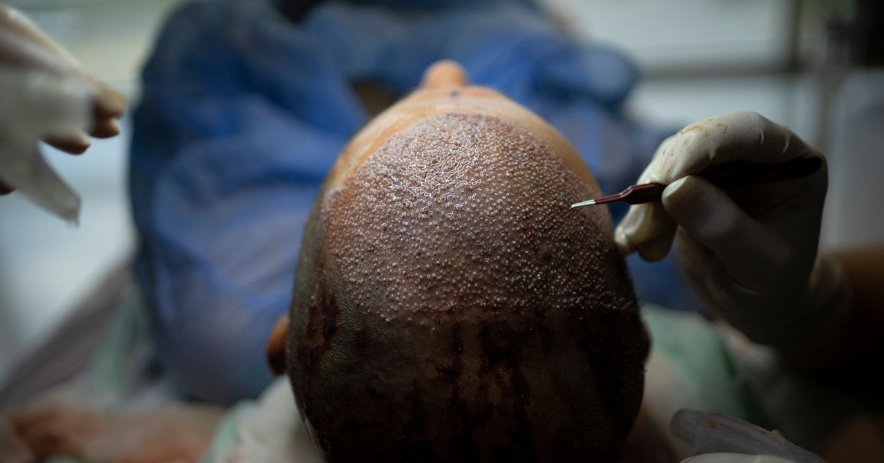 How Turkey Hacked the Hair Transplant Industry | WIRED