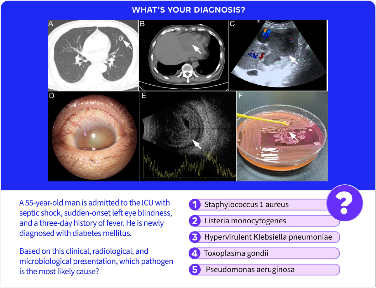 The Five Virulence Genes: Molecular Basis Of Hypervirulence - visual representation
