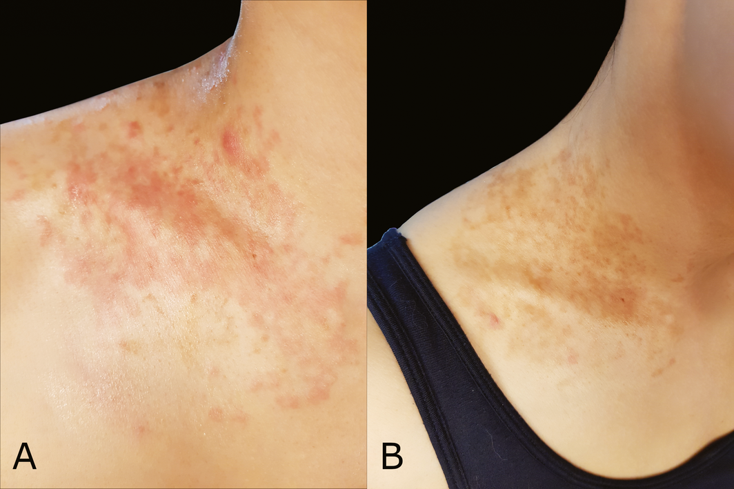 Other Metabolic States Linked to Prurigo Pigmentosa - visual representation
