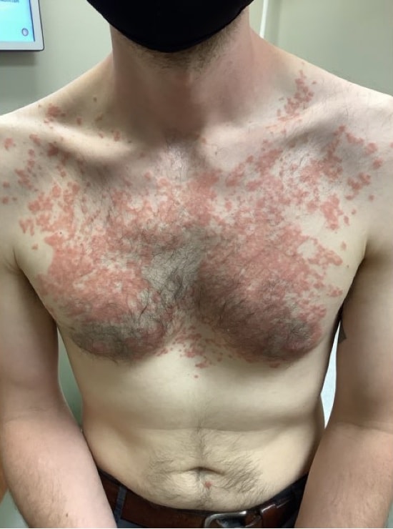 Long-Term Outlook: Can You Do Keto If You're Prone to the Rash - visual representation
