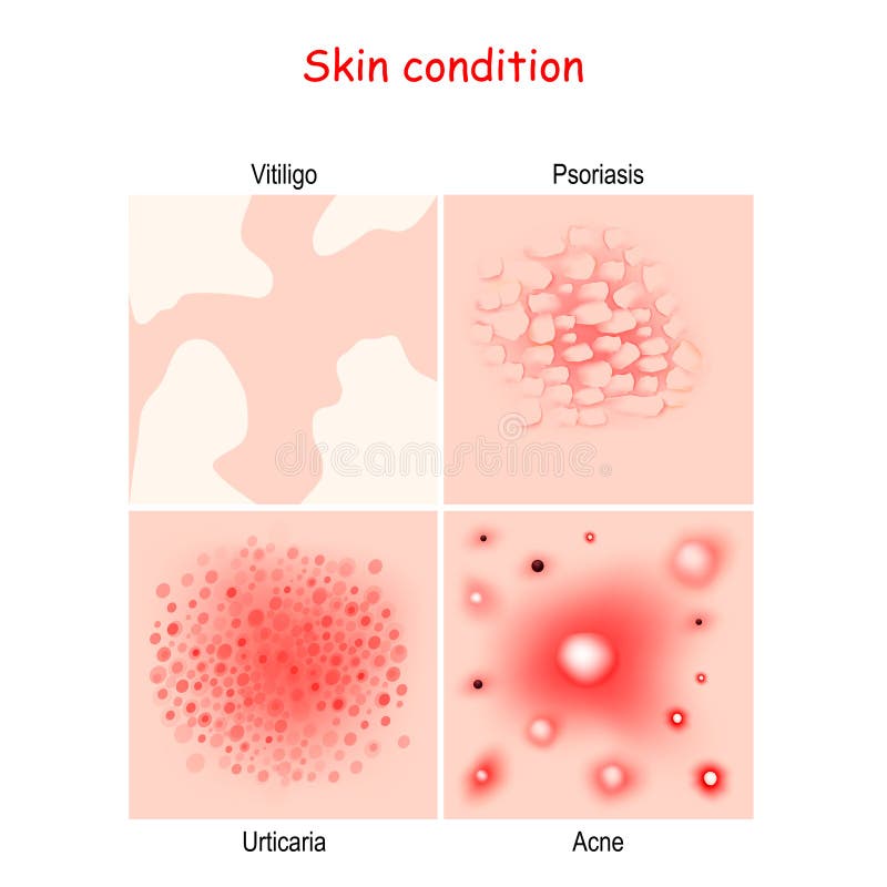 What Is Prurigo Pigmentosa and Why Does It Matter - visual representation