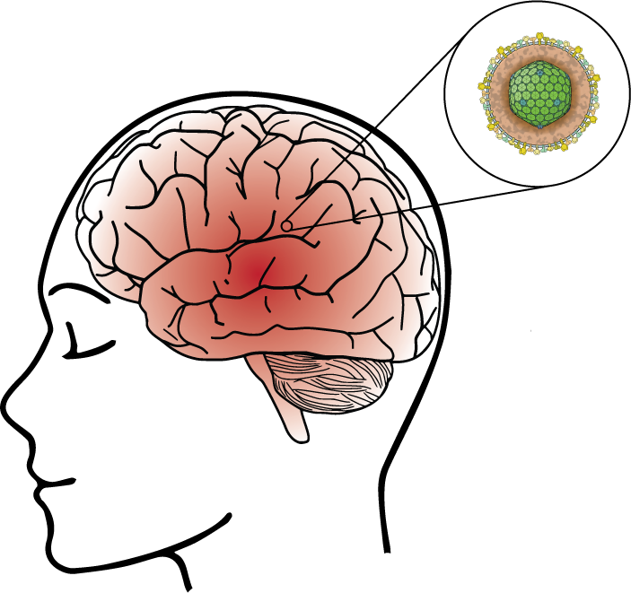 What Is Encephalitis and Why Does It Matter - visual representation