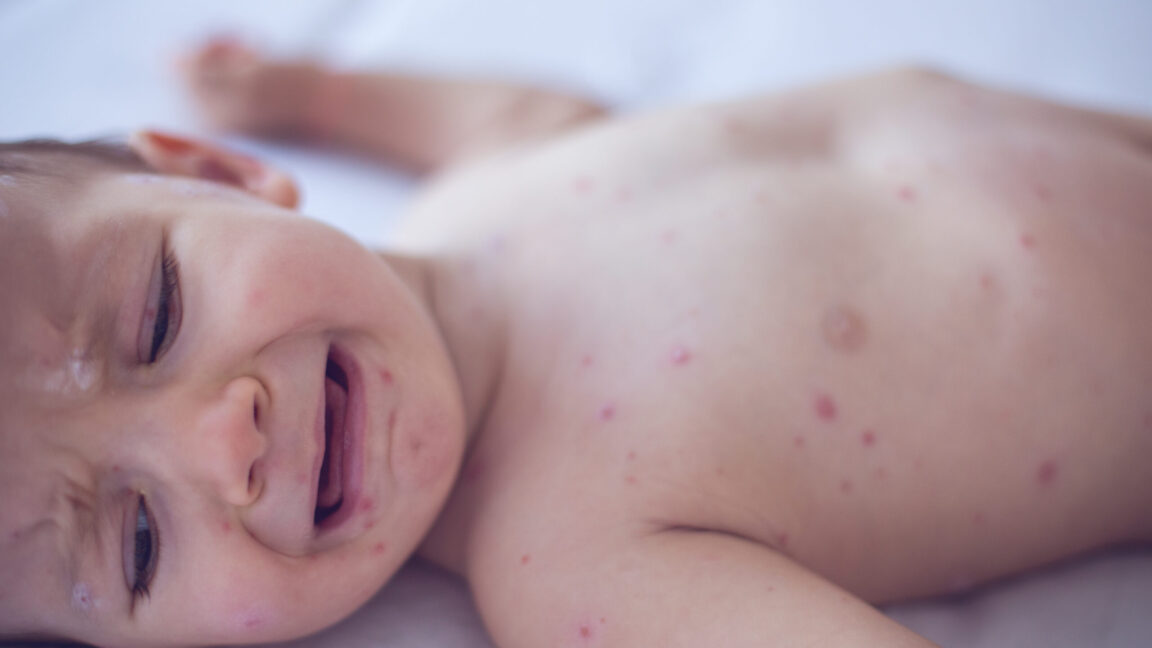 Measles killed 6-week-old baby, coroner confirms after RFK Jr. disputed deaths - Ars Technica