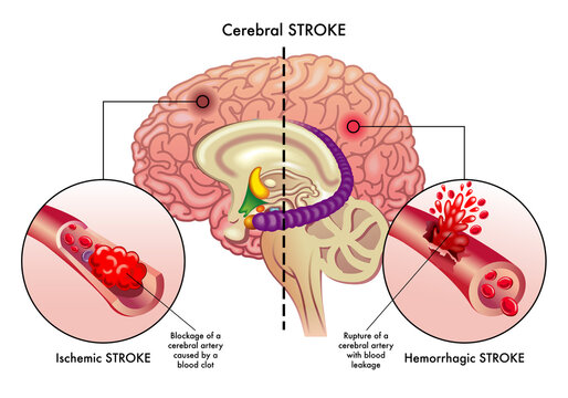 Understanding Stroke and Its Impact - contextual illustration