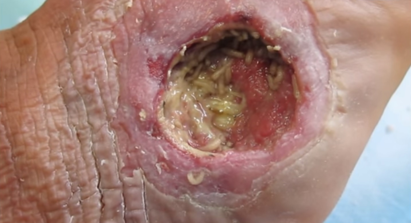 Future Trends in Maggot Therapy - visual representation