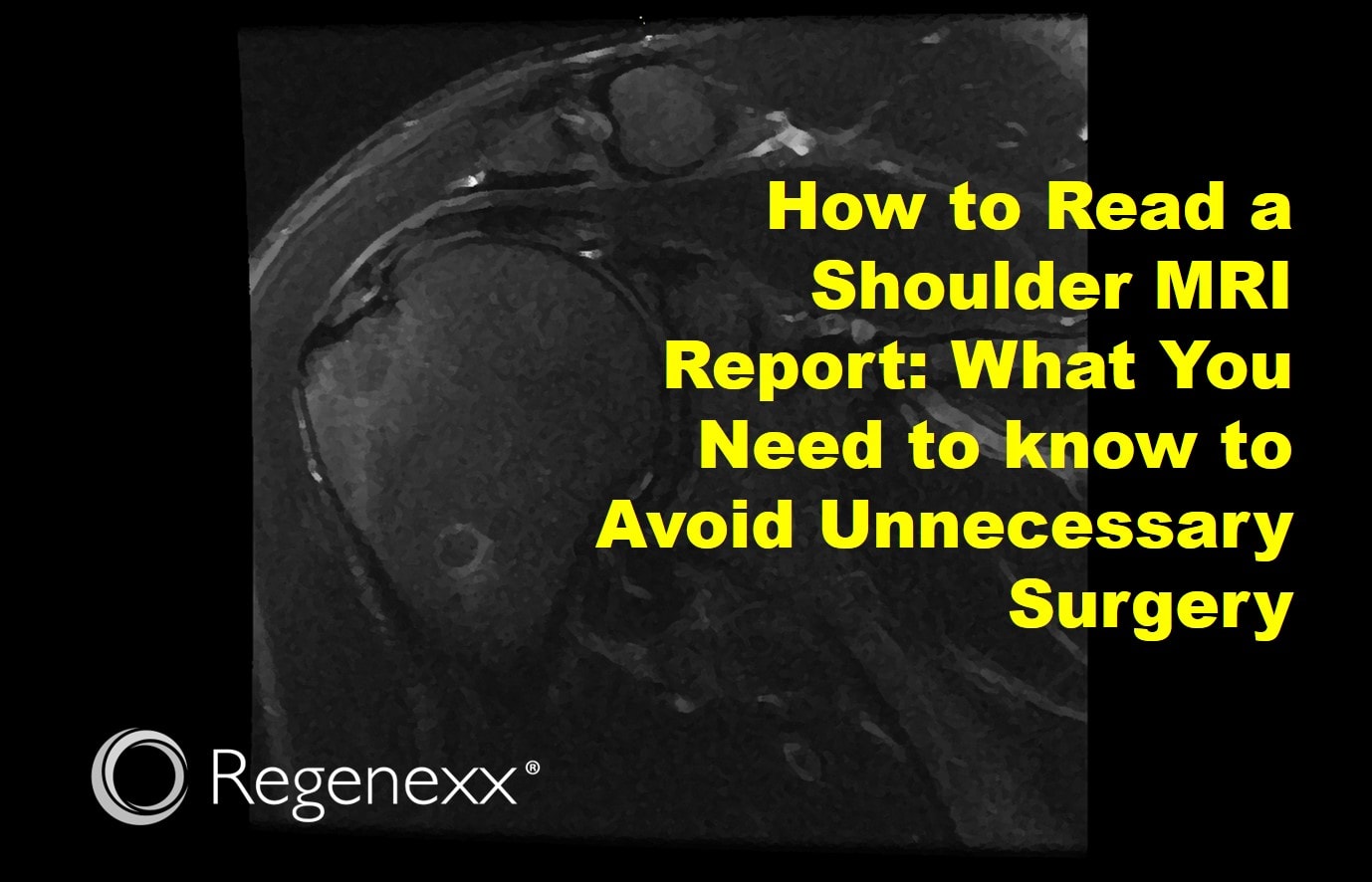 Key Takeaways on Shoulder MRI and Diagnosis - visual representation