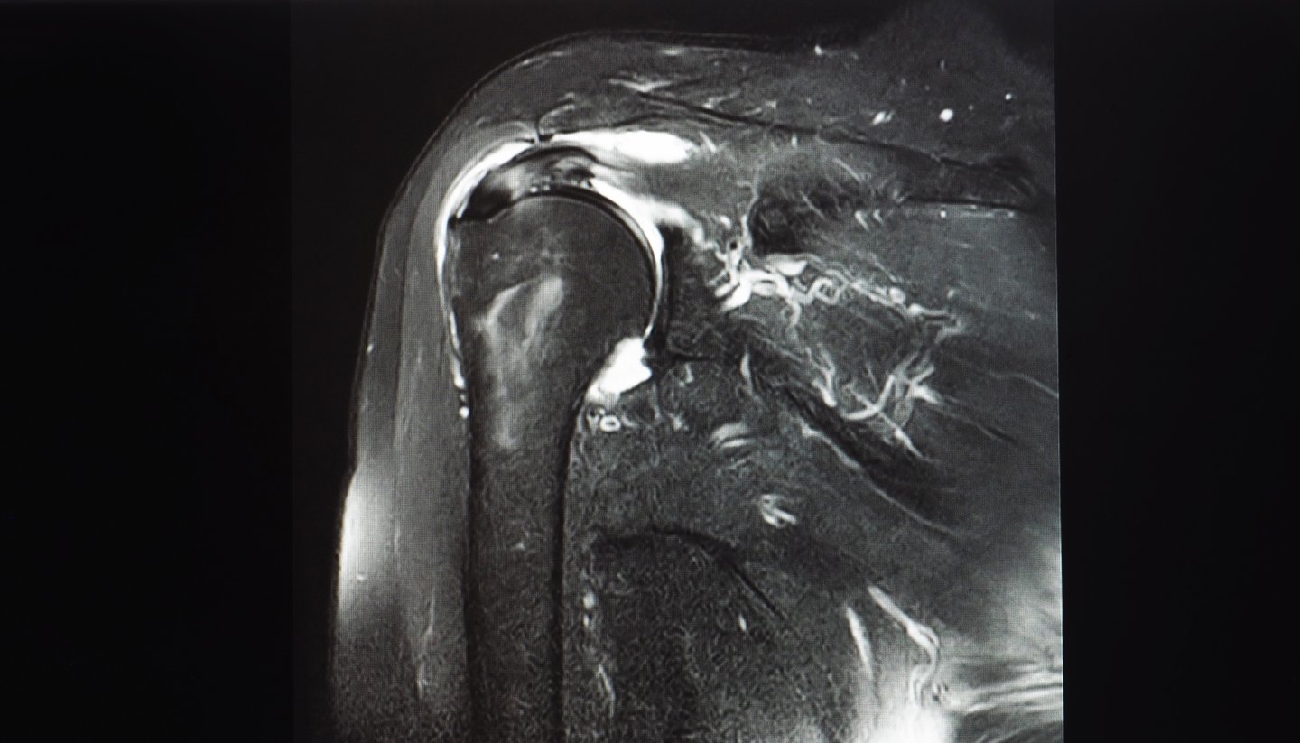 Why MRI Abnormalities Don't Equal "You Need Surgery" - visual representation