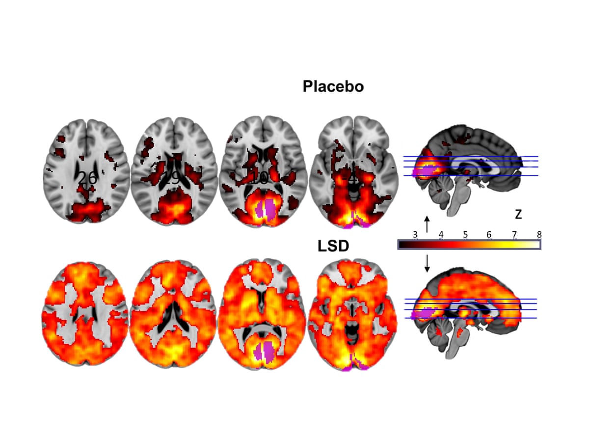 Full-Dose Psilocybin Therapy: A Different Story - visual representation