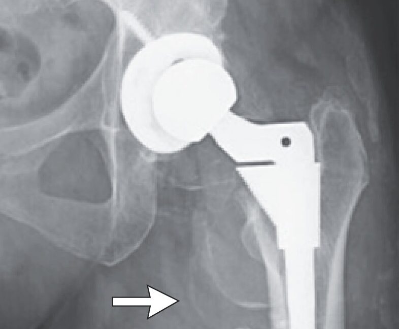 Woman's hip replacement disintegrates, causing severe metal poisoning - Ars Technica